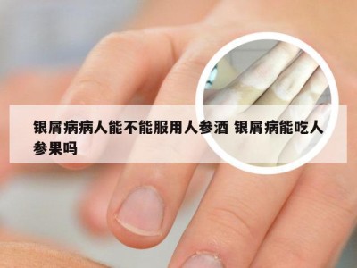 银屑病病人能不能服用人参酒 银屑病能吃人参果吗