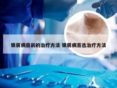 银屑病目前的治疗方法 银屑病首选治疗方法