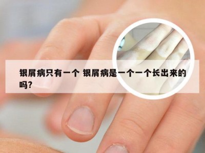 银屑病只有一个 银屑病是一个一个长出来的吗?