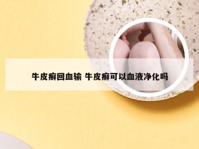 牛皮癣回血输 牛皮癣可以血液净化吗