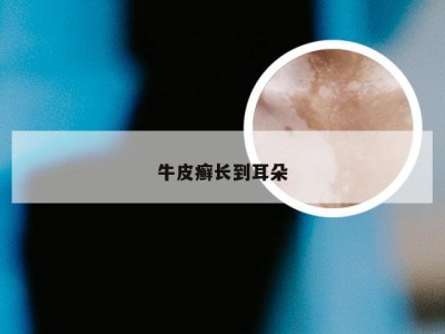 牛皮癣长到耳朵