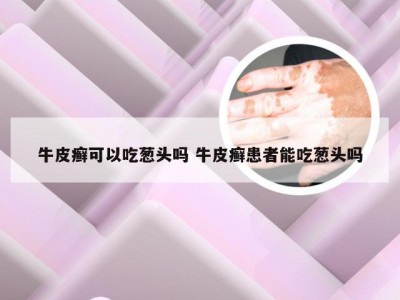 牛皮癣可以吃葱头吗 牛皮癣患者能吃葱头吗