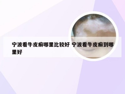 宁波看牛皮癣哪里比较好 宁波看牛皮癣到哪里好