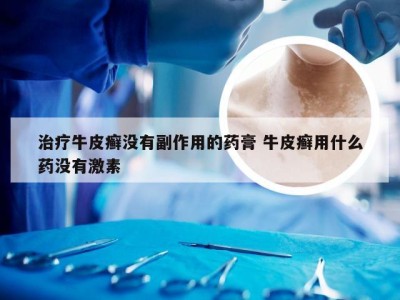 治疗牛皮癣没有副作用的药膏 牛皮癣用什么药没有激素