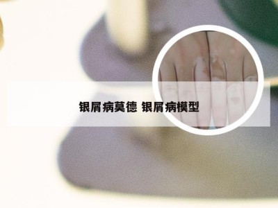 银屑病莫德 银屑病模型