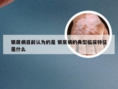 银屑病目前认为的是 银屑病的典型临床特征是什么
