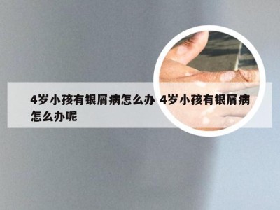 4岁小孩有银屑病怎么办 4岁小孩有银屑病怎么办呢