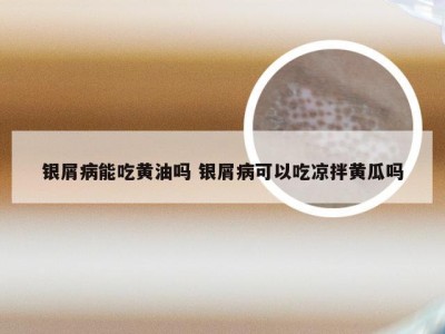银屑病能吃黄油吗 银屑病可以吃凉拌黄瓜吗