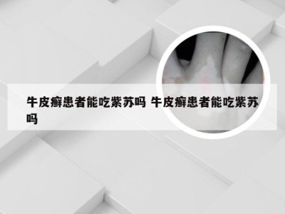 牛皮癣患者能吃紫苏吗 牛皮癣患者能吃紫苏吗