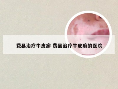 费县治疗牛皮癣 费县治疗牛皮癣的医院