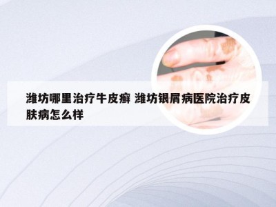潍坊哪里治疗牛皮癣 潍坊银屑病医院治疗皮肤病怎么样
