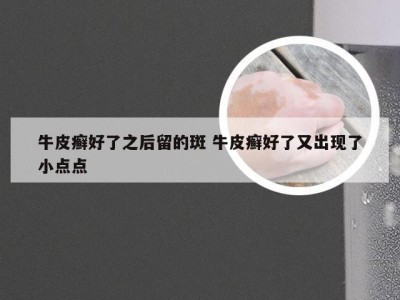 牛皮癣好了之后留的斑 牛皮癣好了又出现了小点点