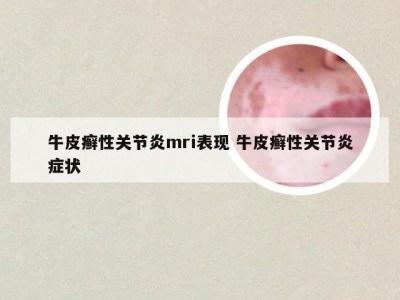牛皮癣性关节炎mri表现 牛皮癣性关节炎症状