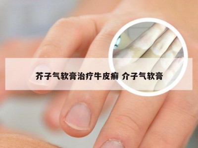 芥子气软膏治疗牛皮癣 介子气软膏