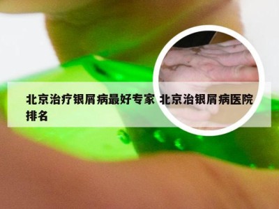 北京治疗银屑病最好专家 北京治银屑病医院排名