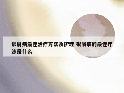 银屑病最佳治疗方法及护理 银屑病的最佳疗法是什么