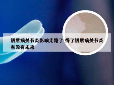 银屑病关节炎影响走路了 得了银屑病关节炎有没有未来