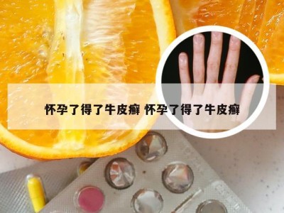 怀孕了得了牛皮癣 怀孕了得了牛皮癣