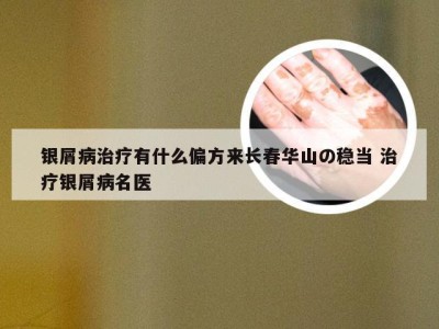 银屑病治疗有什么偏方来长春华山の稳当 治疗银屑病名医