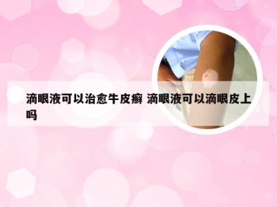 滴眼液可以治愈牛皮癣 滴眼液可以滴眼皮上吗