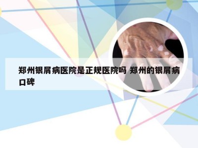 郑州银屑病医院是正规医院吗 郑州的银屑病口碑