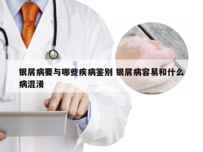 银屑病要与哪些疾病鉴别 银屑病容易和什么病混淆
