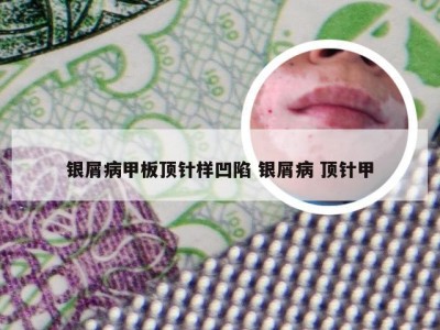 银屑病甲板顶针样凹陷 银屑病 顶针甲