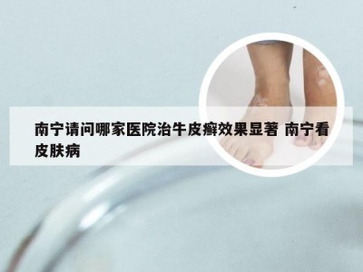 南宁请问哪家医院治牛皮癣效果显著 南宁看皮肤病