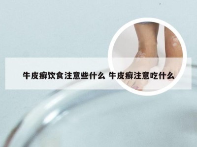 牛皮癣饮食注意些什么 牛皮癣注意吃什么