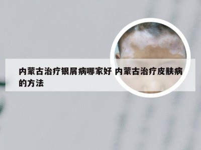 内蒙古治疗银屑病哪家好 内蒙古治疗皮肤病的方法