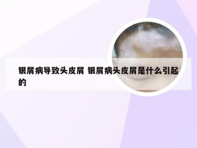 银屑病导致头皮屑 银屑病头皮屑是什么引起的