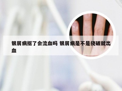 银屑病抠了会流血吗 银屑病是不是挠破就出血