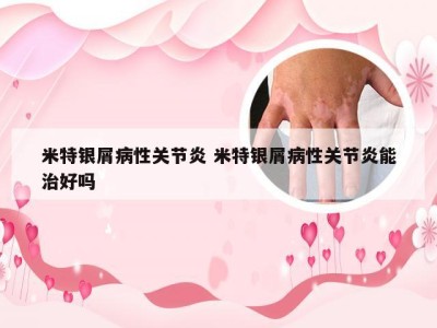 米特银屑病性关节炎 米特银屑病性关节炎能治好吗