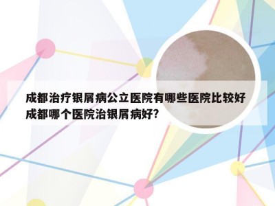 成都治疗银屑病公立医院有哪些医院比较好 成都哪个医院治银屑病好?