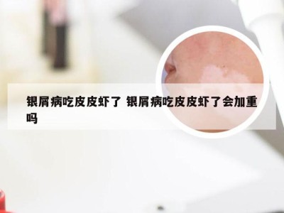 银屑病吃皮皮虾了 银屑病吃皮皮虾了会加重吗