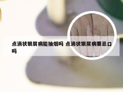 点滴状银屑病能抽烟吗 点滴状银屑病要忌口吗