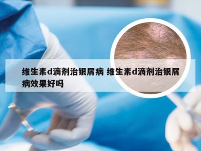 维生素d滴剂治银屑病 维生素d滴剂治银屑病效果好吗