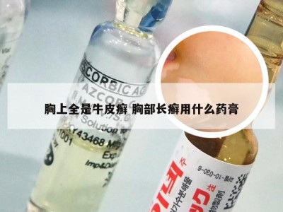 胸上全是牛皮癣 胸部长癣用什么药膏