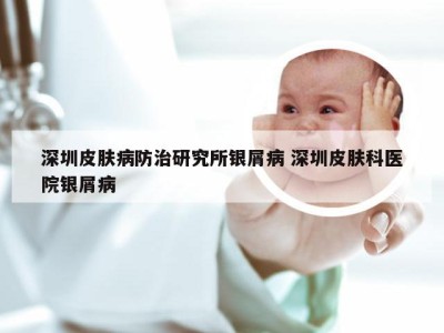 深圳皮肤病防治研究所银屑病 深圳皮肤科医院银屑病