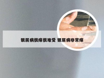 银屑病很痒很难受 银屑病非常痒