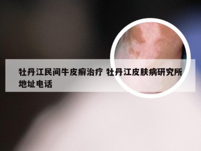 牡丹江民间牛皮癣治疗 牡丹江皮肤病研究所地址电话