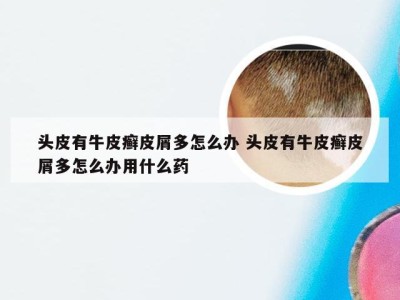 头皮有牛皮癣皮屑多怎么办 头皮有牛皮癣皮屑多怎么办用什么药