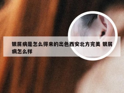 银屑病是怎么得来的出色西安北方完美 银屑病怎么样