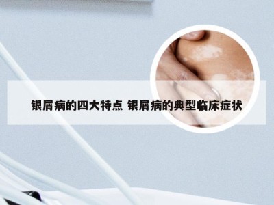 银屑病的四大特点 银屑病的典型临床症状