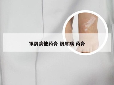 银屑病他药膏 银屑病 药膏