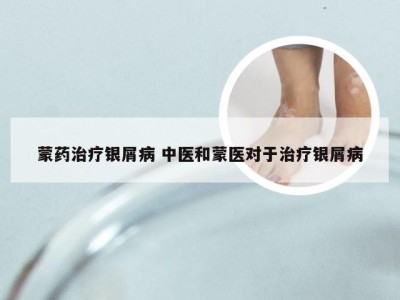 蒙药治疗银屑病 中医和蒙医对于治疗银屑病
