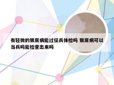 有轻微的银屑病能过征兵体检吗 银屑病可以当兵吗能检查出来吗
