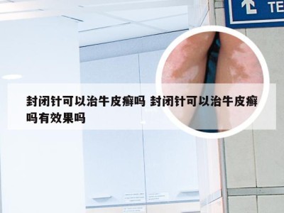 封闭针可以治牛皮癣吗 封闭针可以治牛皮癣吗有效果吗
