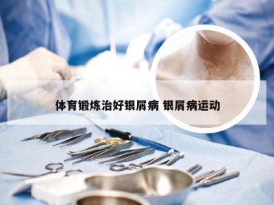 体育锻炼治好银屑病 银屑病运动