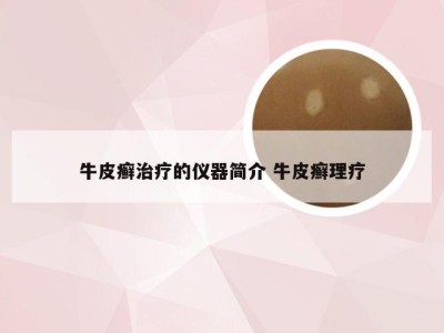 牛皮癣治疗的仪器简介 牛皮癣理疗